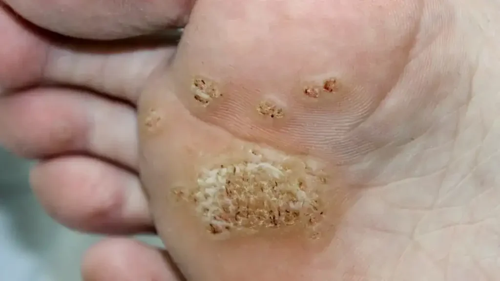 Secure Your Wart Removal Appointment with One Click Brighton