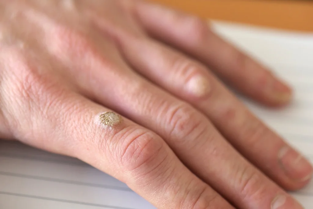 FAQs – Do Warts Return After CryoPen Treatment Brighton